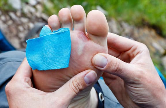Blisters 9 Step Plan For Treating Blisters On The Run Cts