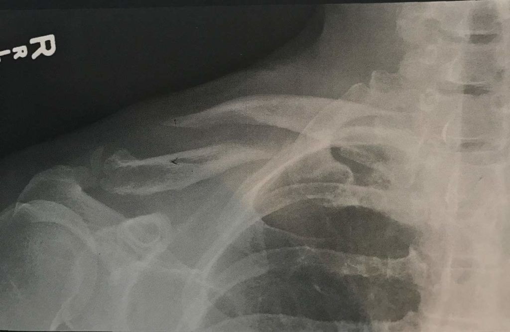 carmichael collarbone