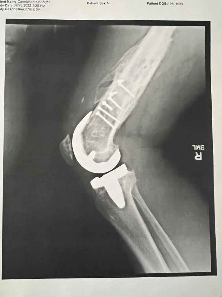 Knee Replacement Training Plan: Returning to Cycling and Sport after Total Knee Replacement 6 knee replacement xray