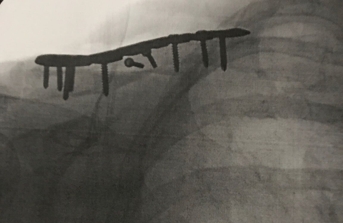CC Collarbone repair newsletter