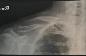 Carmichael collarbone separated