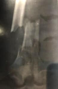 CC Femur