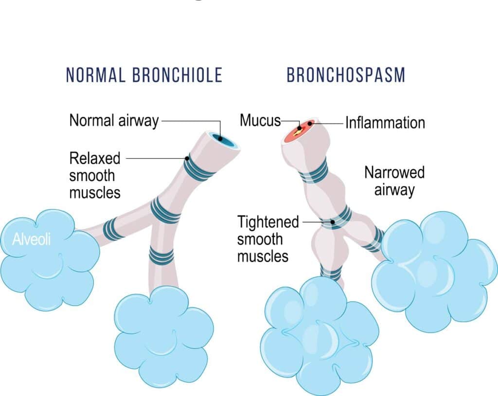 Can Training in Extreme Cold Permanently Hurt Your Lungs? 2 bronchospasm