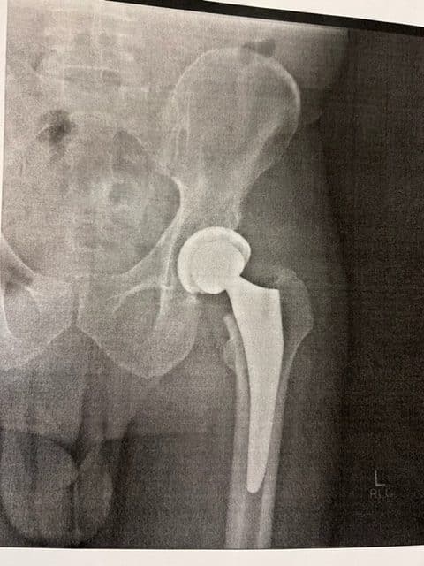 The Hip Replacement Training Plan: Returning to Cycling and Sport after Total Hip Arthroplasty 2 hip replacement