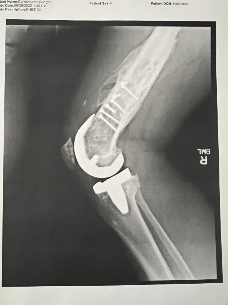 Knee Replacement Training Plan: Returning to Cycling and Sport after Total Knee Replacement 6 knee replacement xray