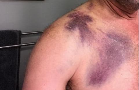 collarbone bruise